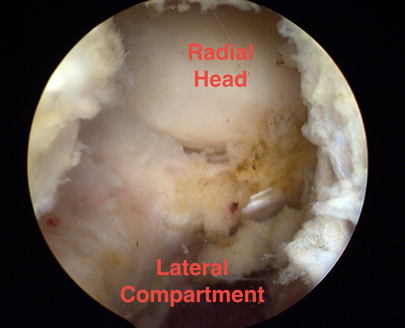 Elbow Arthroscopy Posterolateral 2